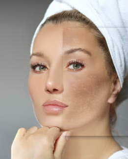 Melasma (Hyperpigmentation)