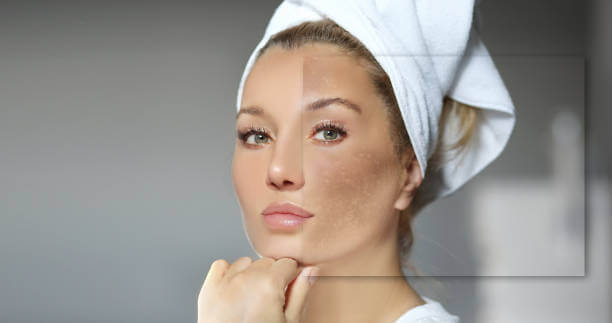 Melasma (Hyperpigmentation) Melasma (Hyperpigmentation)