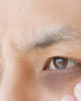 Under Eye Blackness