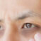 Under Eye Blackness