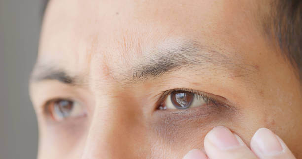 Under Eye Blackness