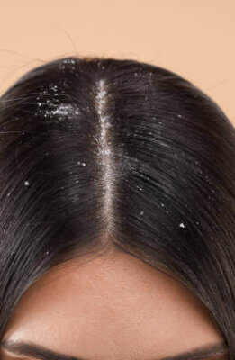 Woman with dandruff in her dark hair on beige background, closeup