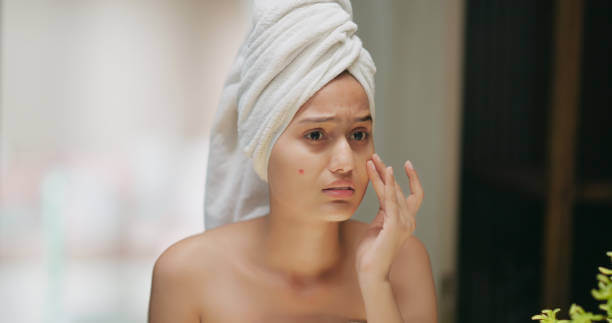Acne & Pimples Acne & Pimples