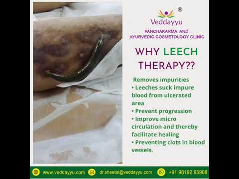 Why Leech Therapy | Veddayyu